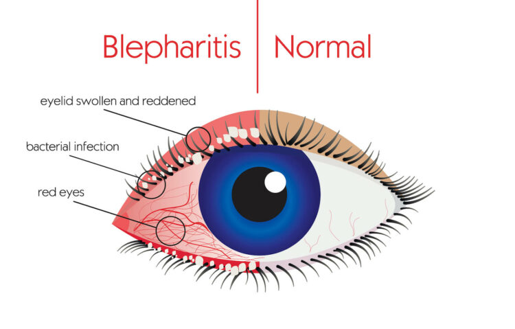 Illustration of Blepharitis vs normal eye