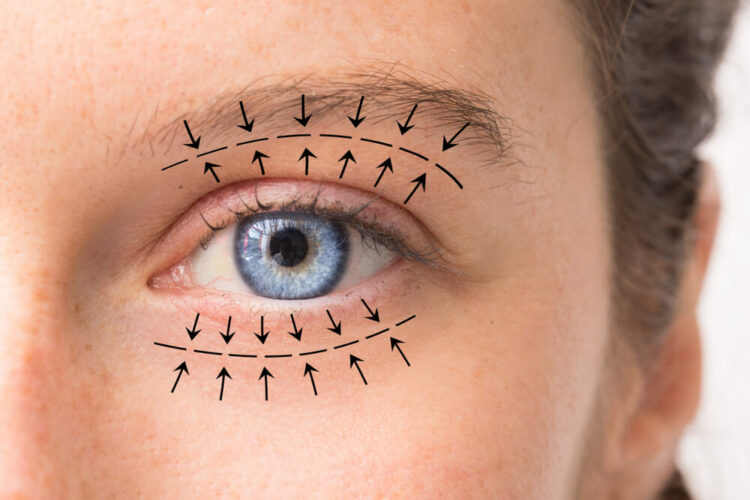 Diagram of eyelid lift