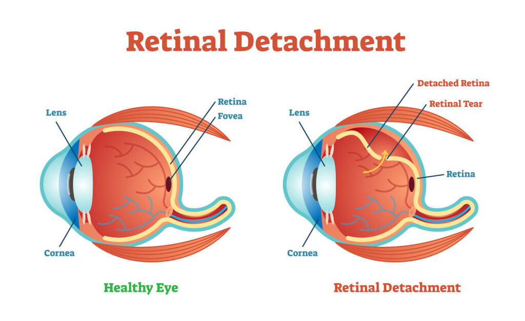etinal Detachment` illustration diagram